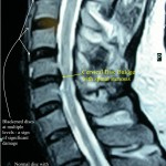 Cervical Disc Herniation