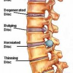 Cervical Disc Herniation