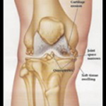 Degenerative Arthritis