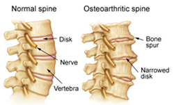 Normal and Osteoarthritic Spine