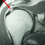 Rotator Cuff Tear MRI